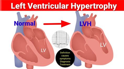 lv hoed|Left Ventricular Hypertrophy (LVH) .